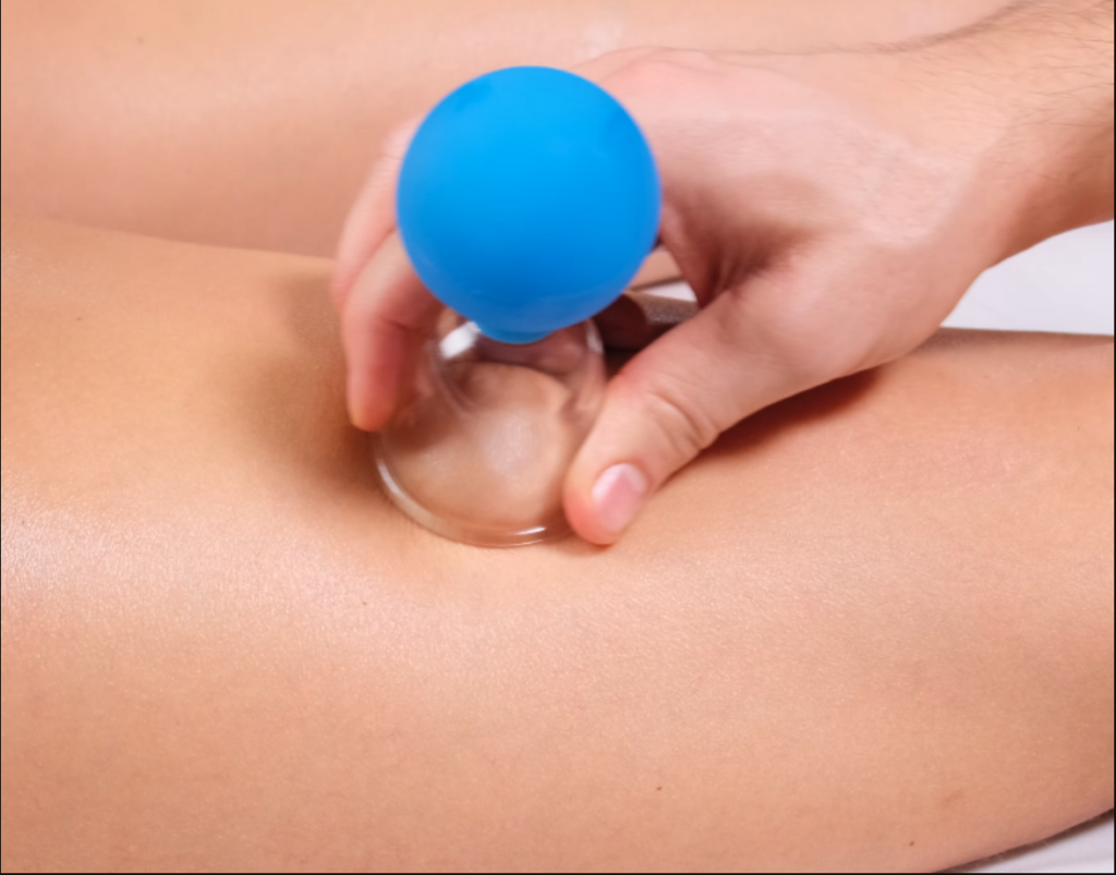 Cupping sportmassage